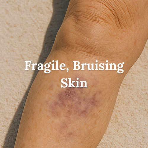 Close-up of a person’s bruised arm with text reading ‘Fragile, Bruising Skin,’ used to represent one of the common skin challenges Miracle of the Sea addresses with care.